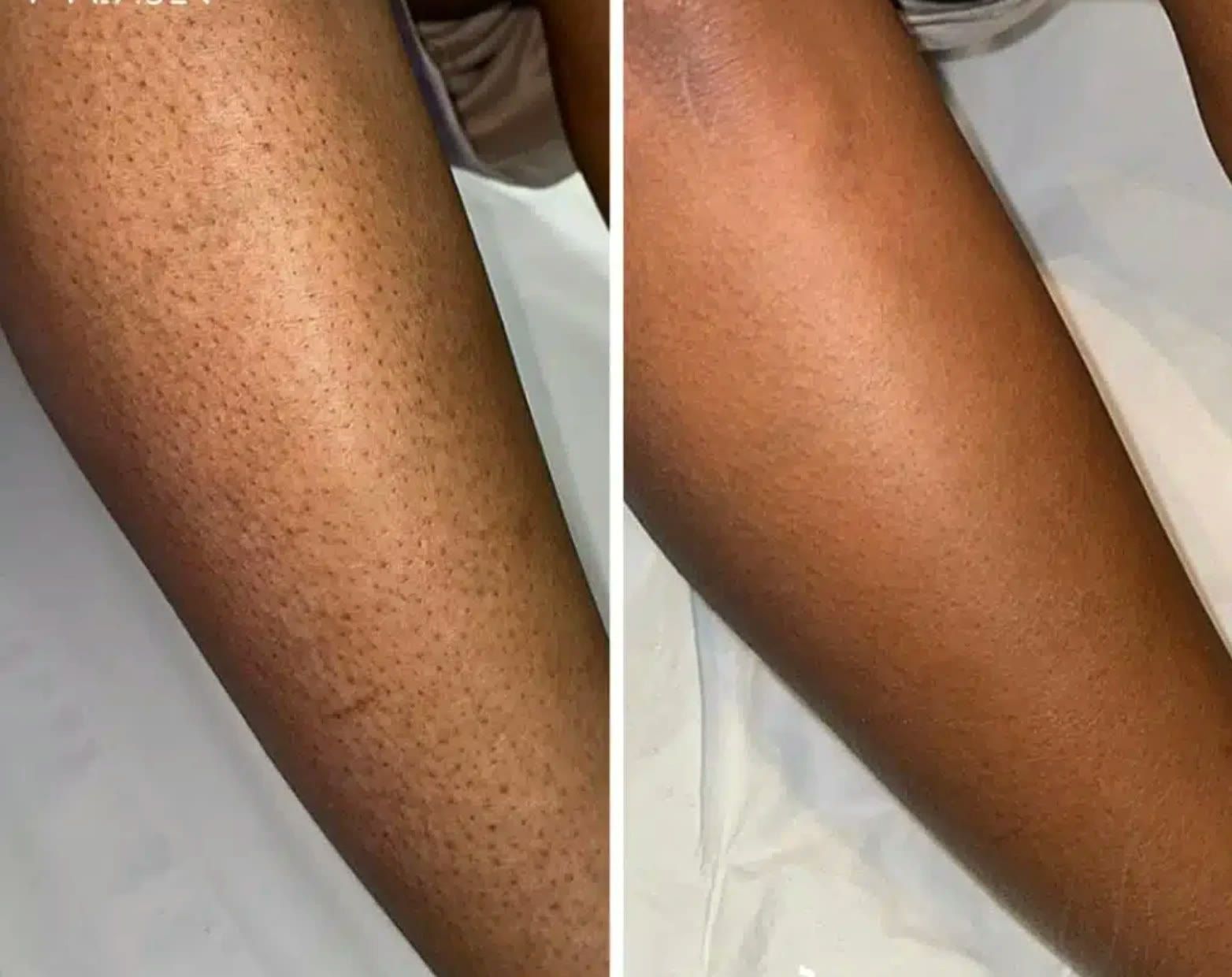 Résultat d'épilation laser, jambes