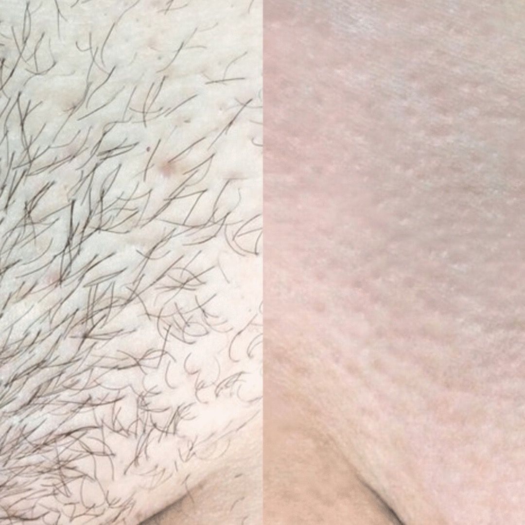 Résultat d'épilation laser, maillot