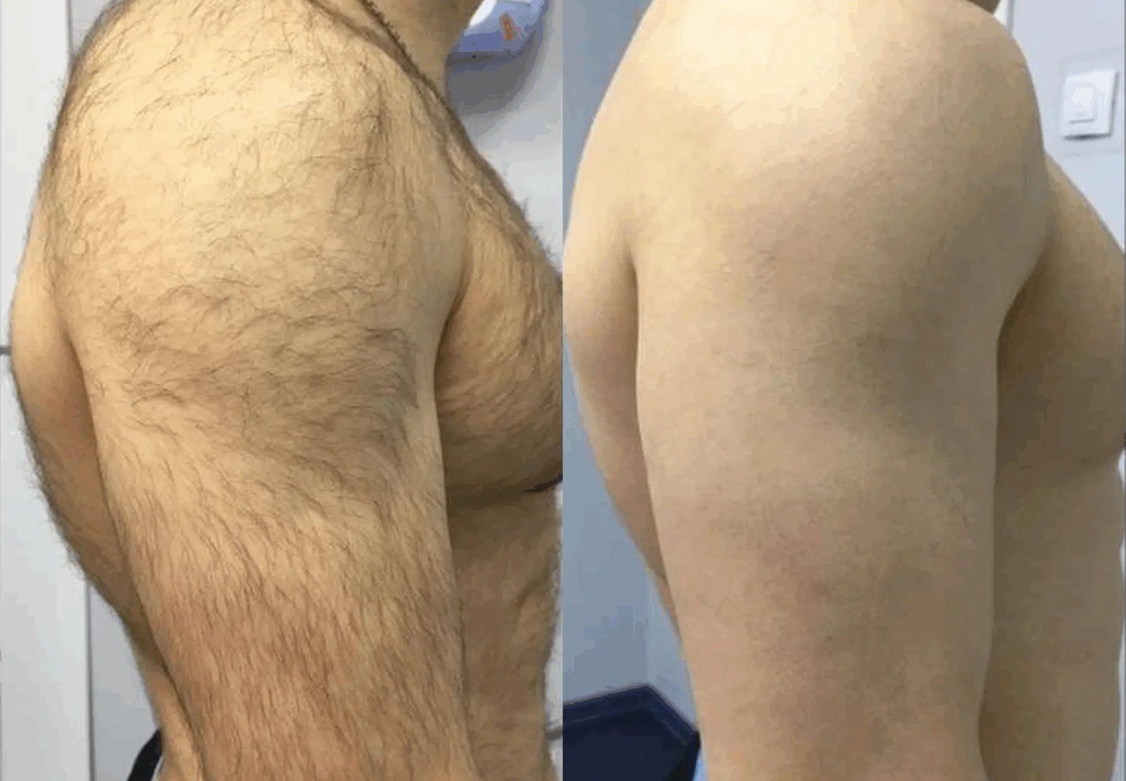 Résultat d'épilation laser, épaule et bras