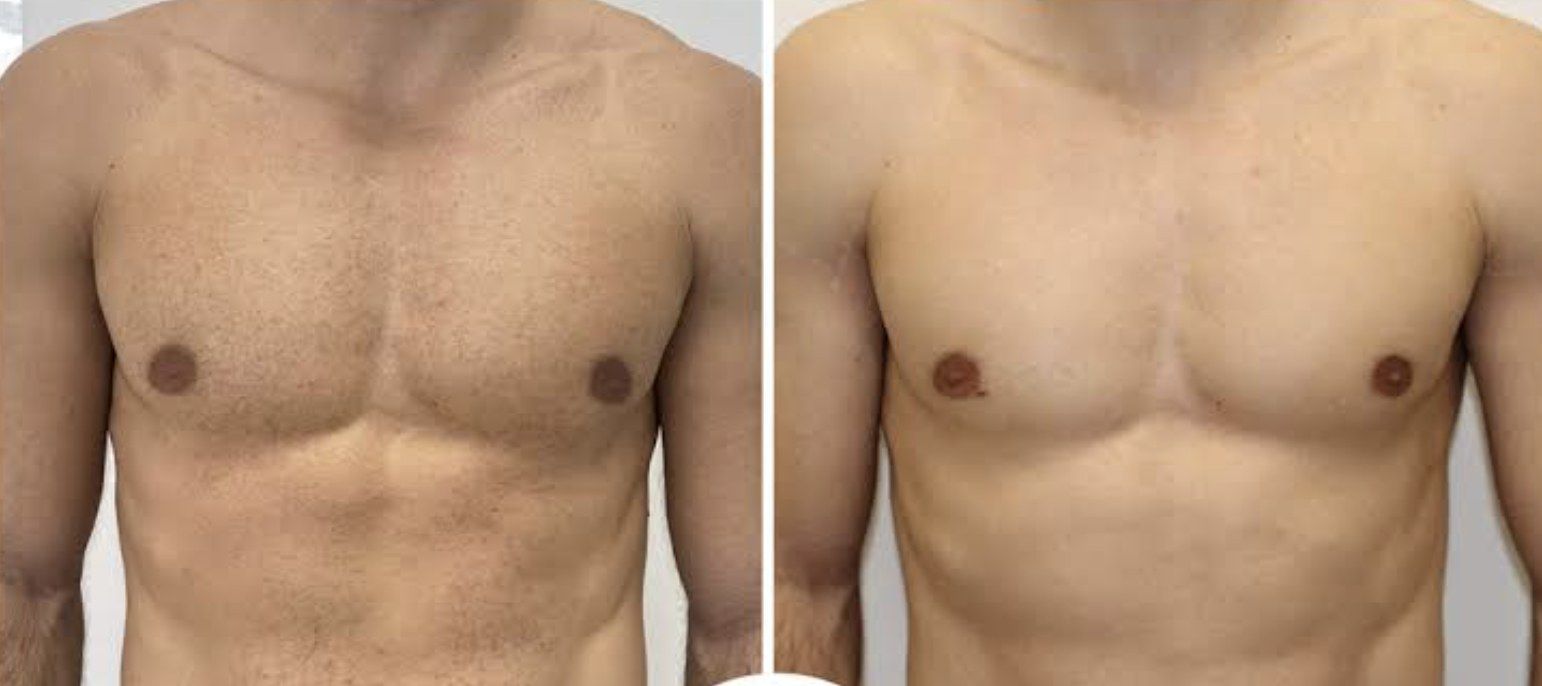 Résultat d'épilation laser, torse